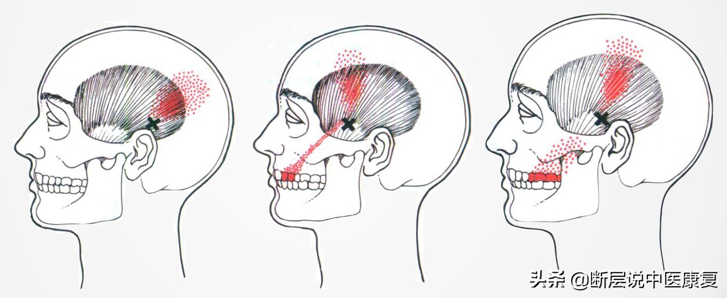 颞部头痛怎么办快速缓解,拉伸颞肌缓解偏头痛