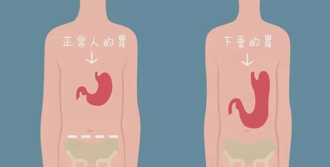 胃下垂病好治吗,胃下垂是怎么回事应该注意啥
