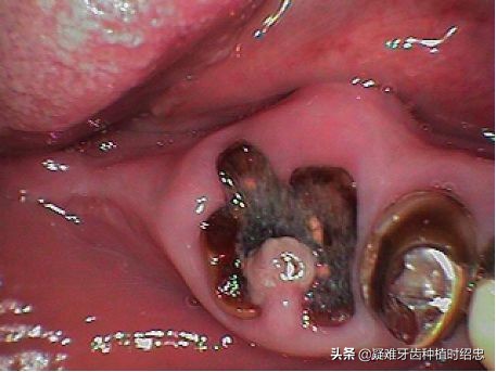 孩子牙只剩残根怎么换牙,只剩残根的牙真的能补救吗