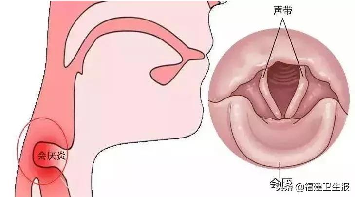 喉咙痛口水难以下咽,喉咙痛吞口水都痛能不能自愈