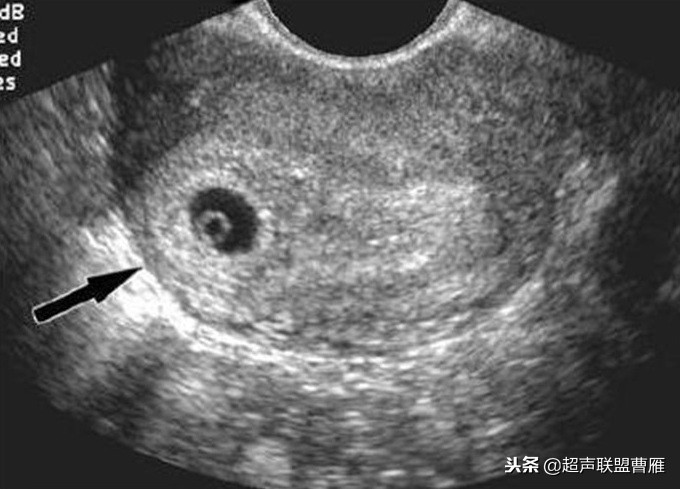 内见卵黄囊,卵黄囊肿瘤