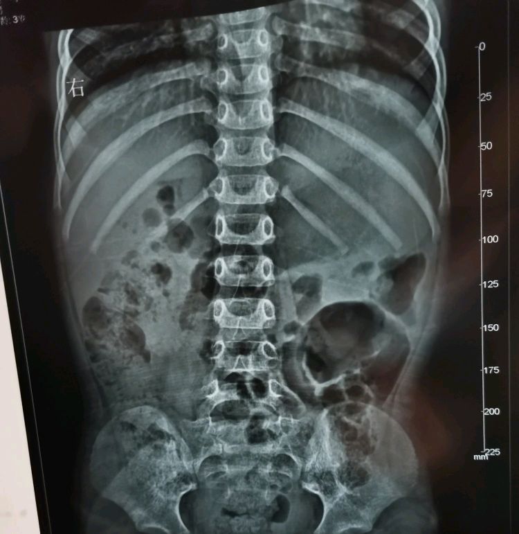 宝宝身上起疙瘩像蚊子咬一样还痒,宝宝身上长疙瘩像蚊虫叮咬怎么办