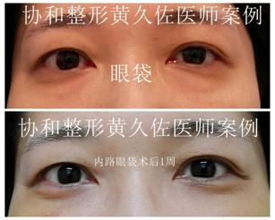 眼袋填充几个月后眼袋松弛皱纹多,眼袋松弛皱纹多用什么方法解决