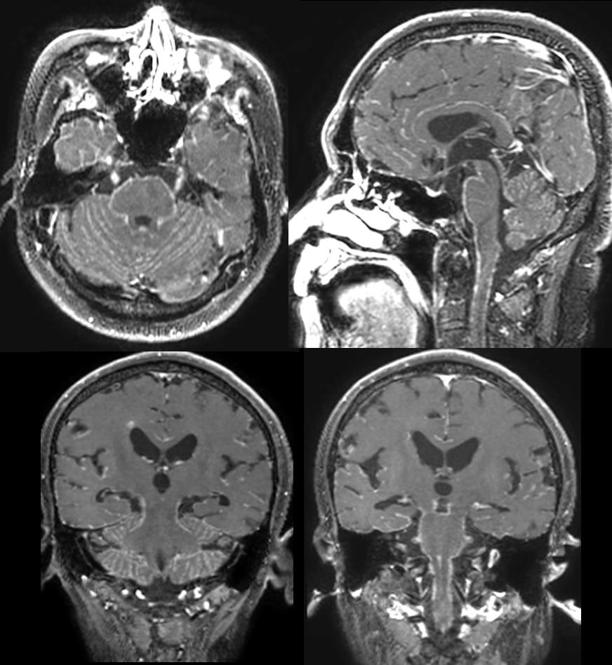 分享一个肺癌脑转移病例
