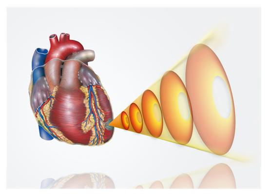 齐鲁医院高海青教授：体外心脏震波—建立冠脉微循环，实现血运重建