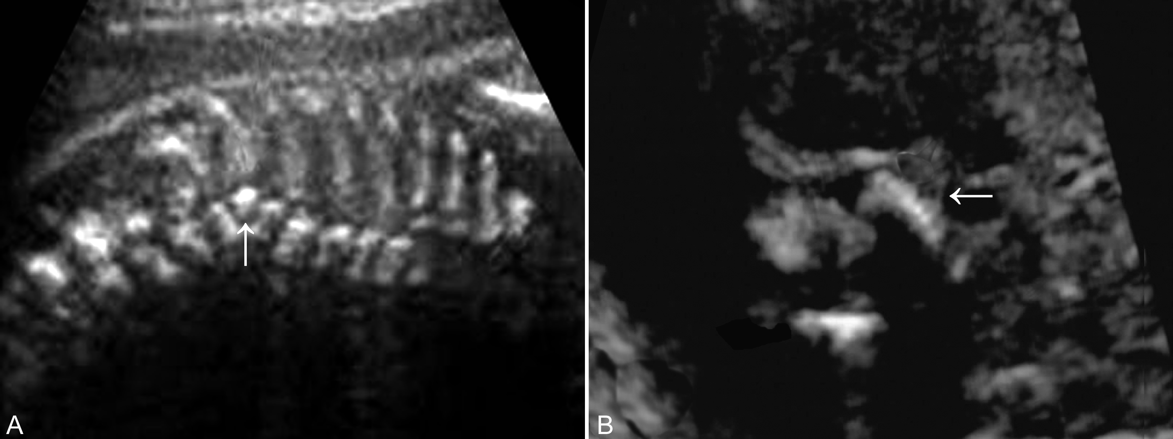 骨密度超声检查,超声全波形