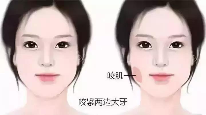 方脸打瘦脸针,打瘦脸针副作用