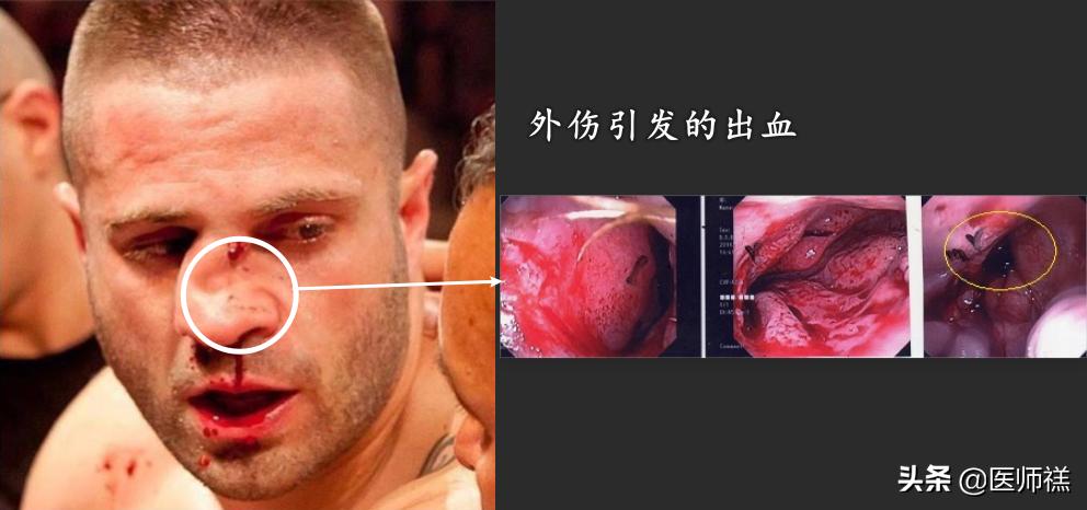 无缘无故的流鼻血是啥原因引起的,经常无缘无故流鼻血要怎么解决