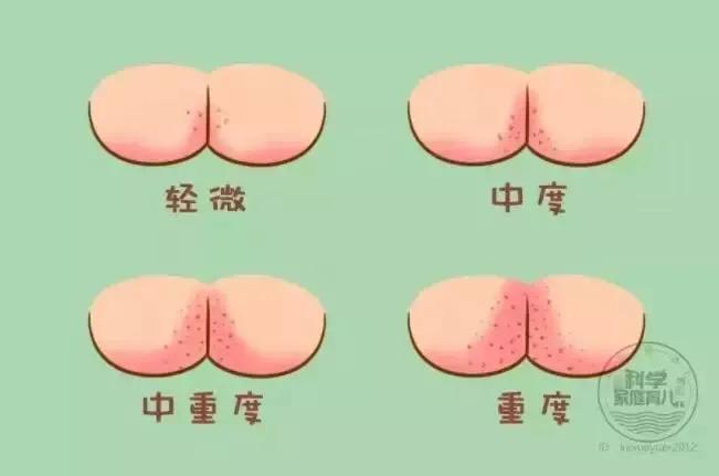 每个孩子都要起疹子吗,小孩起疹子最快的解决办法