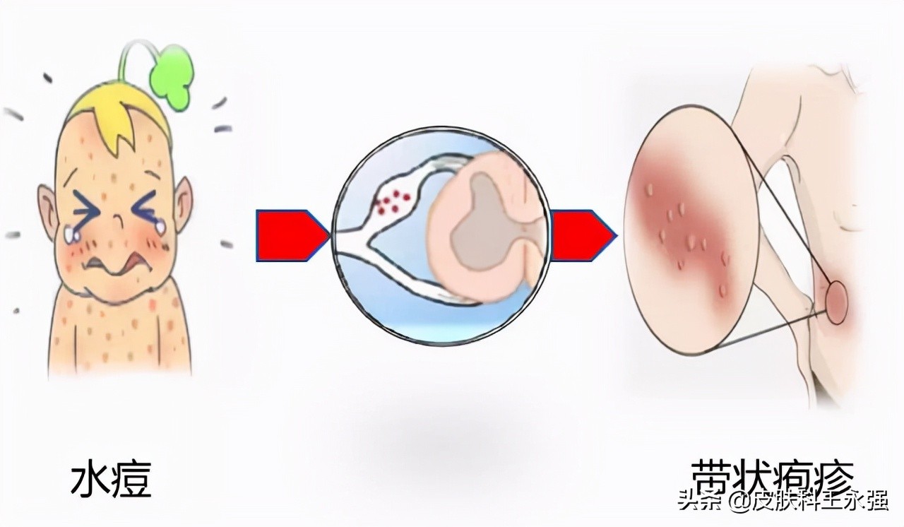 得了带状疱疹可能是什么病的征兆,警惕带状疱疹72小时内必须处理
