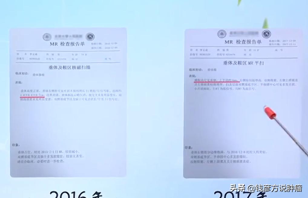 脑垂体核磁发现一个小结节,脑垂体有结节没症状需要手术吗