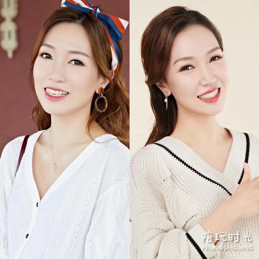 年糕妈妈没矫正牙齿之前样子,年糕妈妈整牙拔牙