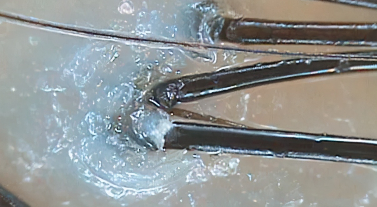 脱落的头发有白色颗粒是毛囊么,连毛囊一起脱落的头发图片