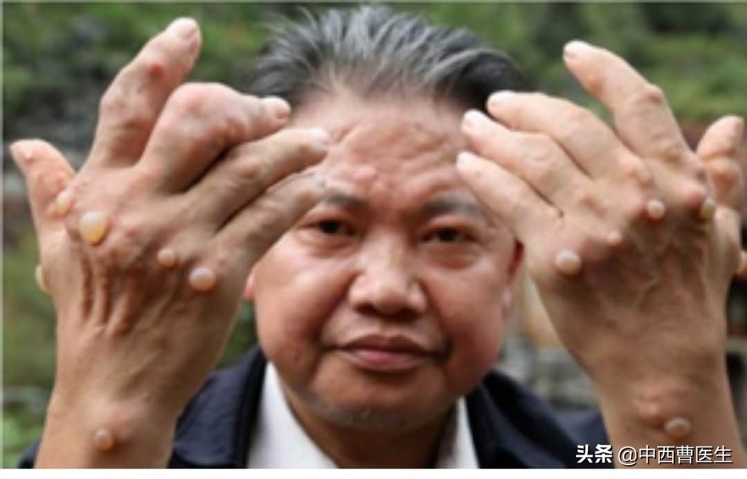 痛风的临床表现及健康教育ppt,痛风的诊断与治疗的内容