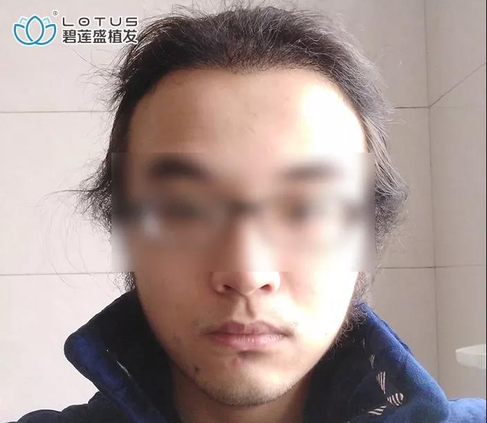 发际线后移额角大头发稀疏怎么办,额角发际线还能恢复吗