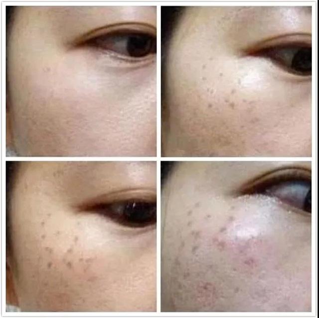 常见的色斑种类图文,脸部常见斑种类及图片
