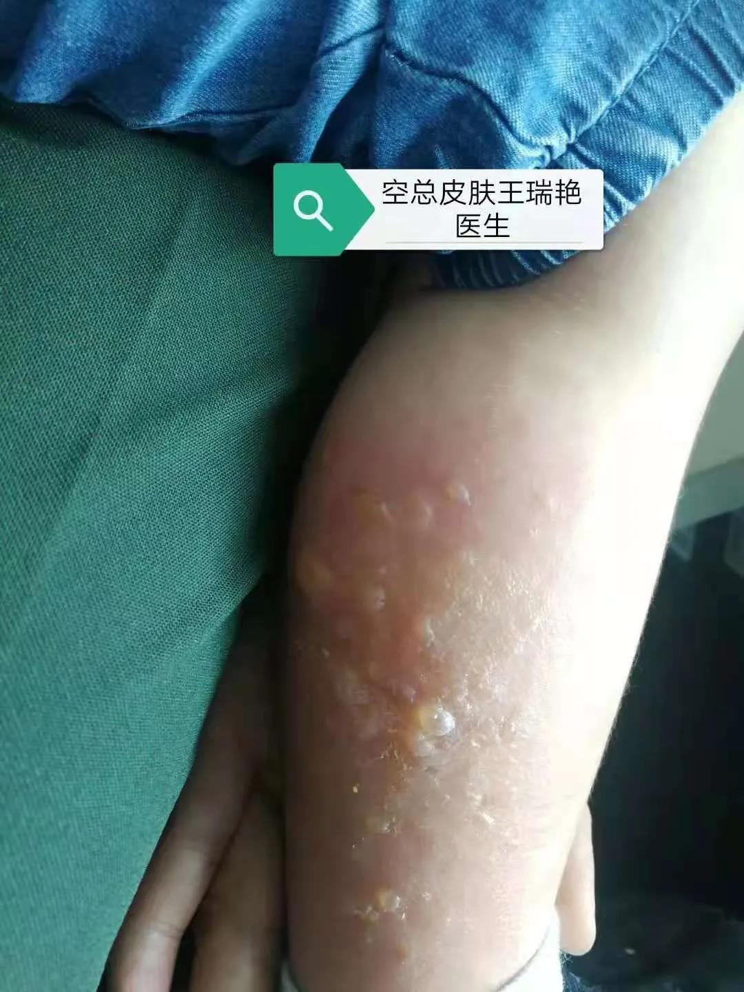 洪水之后需要注意的地方,洪水容易造成什么皮肤病