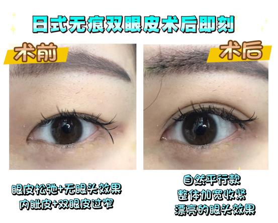 上海九院整形科孙教授,上海九院孙英双眼皮修复