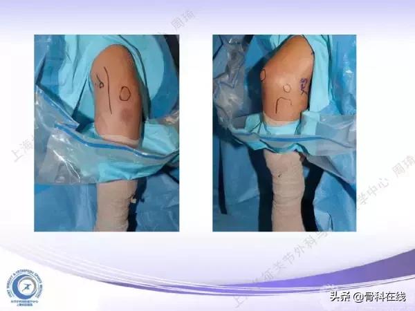 肘关节镜手术后引流,肘关节镜微创手术