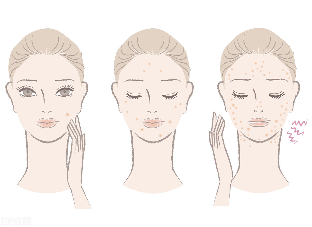 我又长痘了怎么回复,原本脸上没有痘突然脸上爆痘