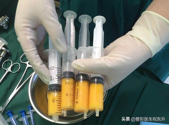 面部脂肪填充一个月皮肤的变化,面部脂肪填充的后脸部真的好了吗