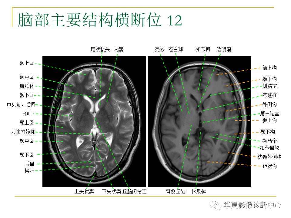 中国人脑立体定向mri应用解剖图谱,脑mri示意图