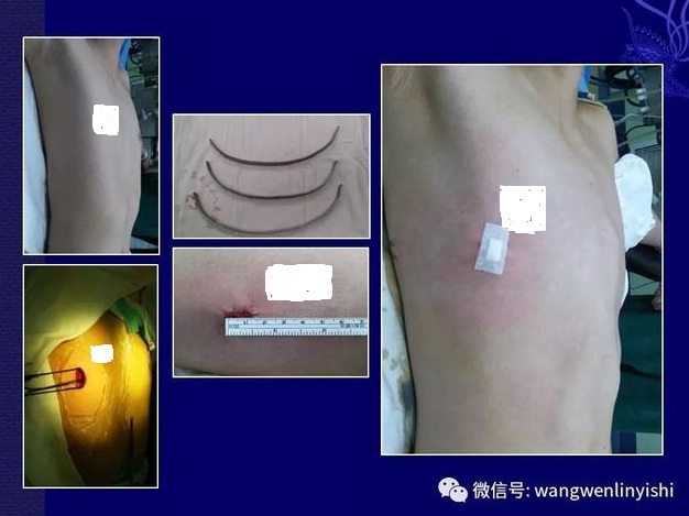 扁平胸合并漏斗胸可以手术矫正吗,扁平胸怎么手术