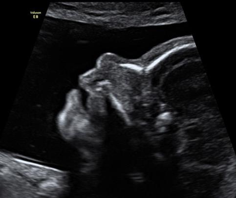 b超能看出胎儿鼻骨吗,b超显示胎儿鼻骨不清什么意思