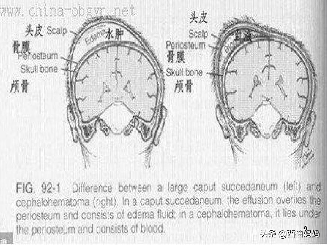 辟谣：“产瘤”十一天还没有消失，变硬就来不及了？要去抽出来？