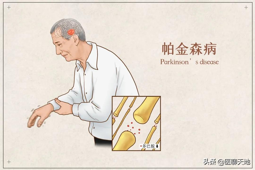 有医说医文小说,医知医道帕金森病