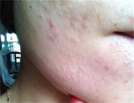 痘痘爆发季告诉你痘痘的形成原因,痘痘长期存在总是爆痘怎么办