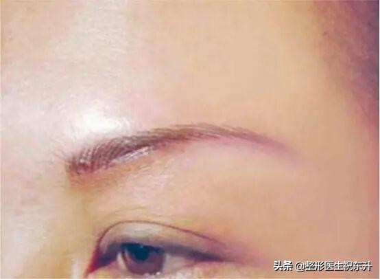 上眼皮松弛下垂做什么手术不留疤,提眉和上眼睑松弛矫正有啥区别