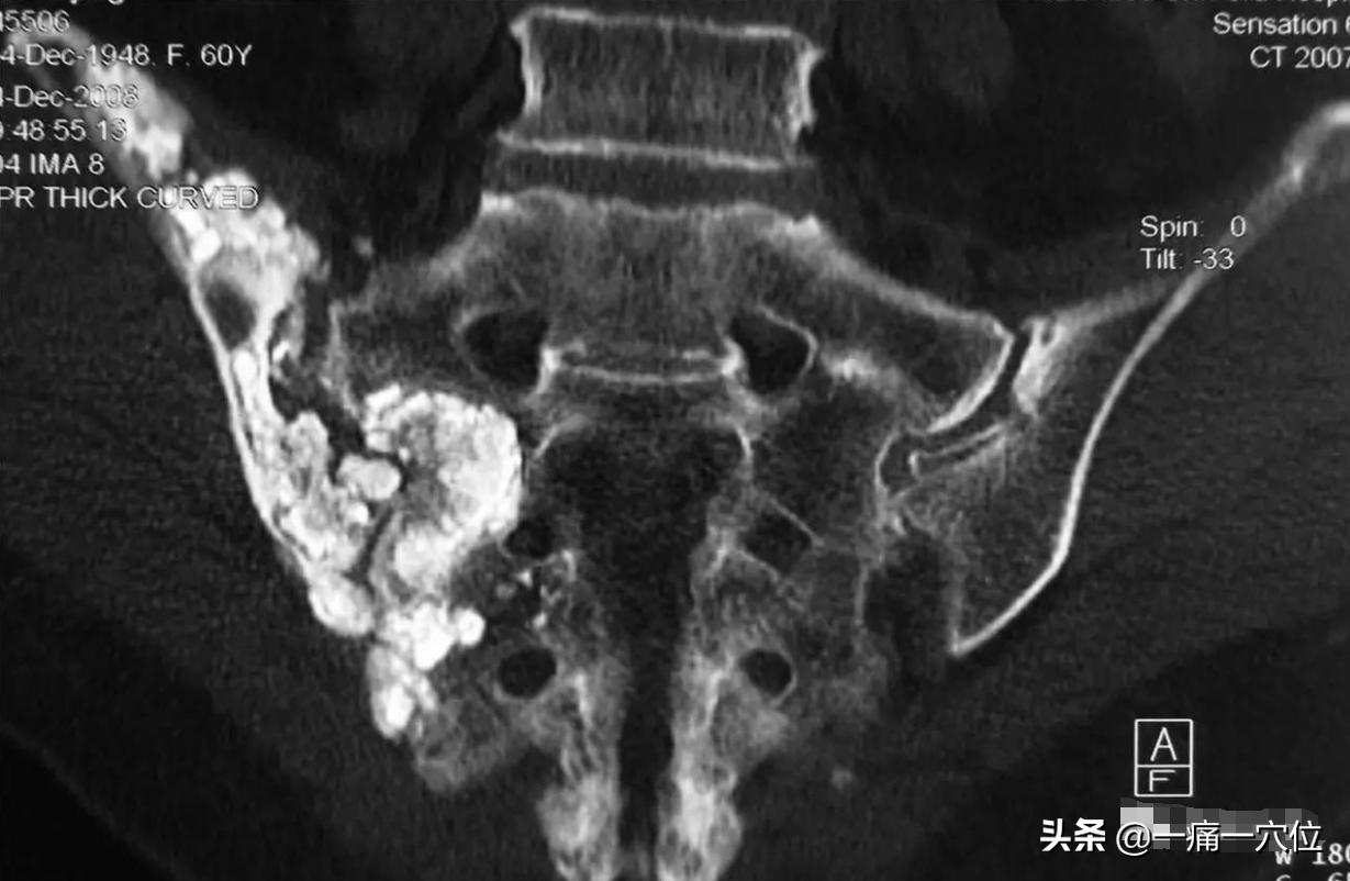 尾骶骨痛灸哪里,尾骶骨按压时候痛是什么原因