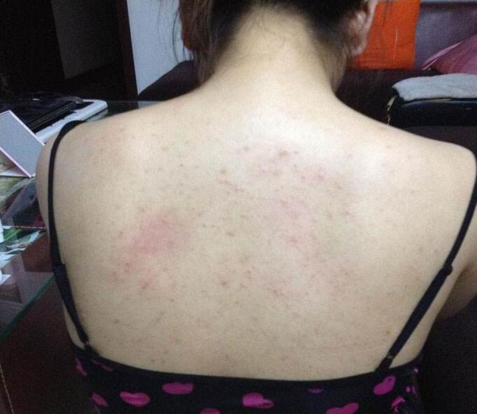 后背长痘怎么内调好,后背长痘痘喝什么内调真实有效