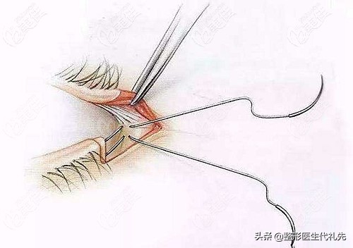祛眼袋眼睑轻度外翻悬吊多久能好,外切口去眼袋面部提升能维持多久