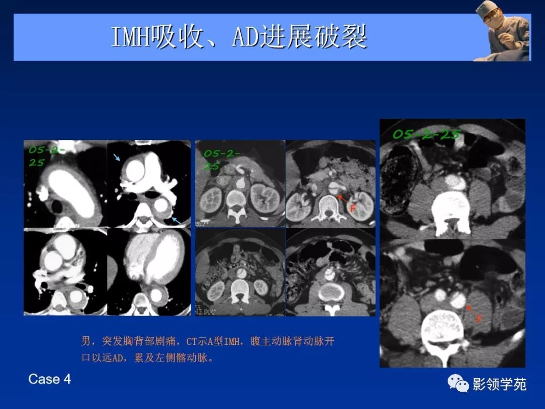 主动脉夹层壁间血肿如何鉴别,主动脉夹层血肿溃疡