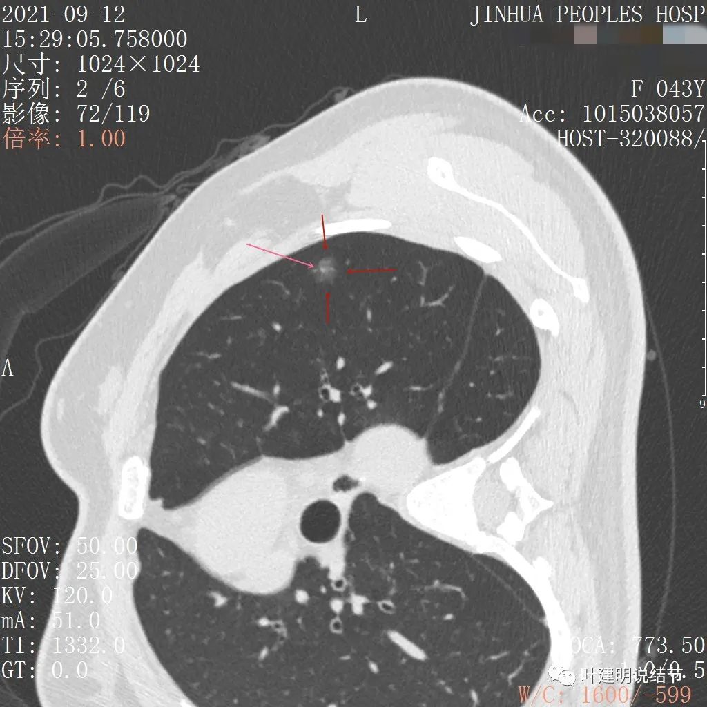 怎样从病理报告看是不是原位癌,原位腺癌切除子宫要开刀吗