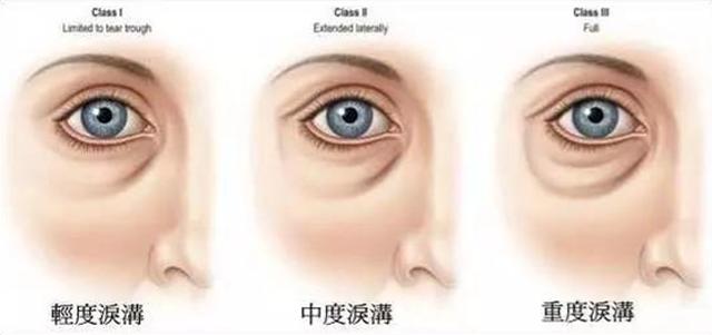 如何让泪沟消失小技巧,泪沟真的毫无办法吗