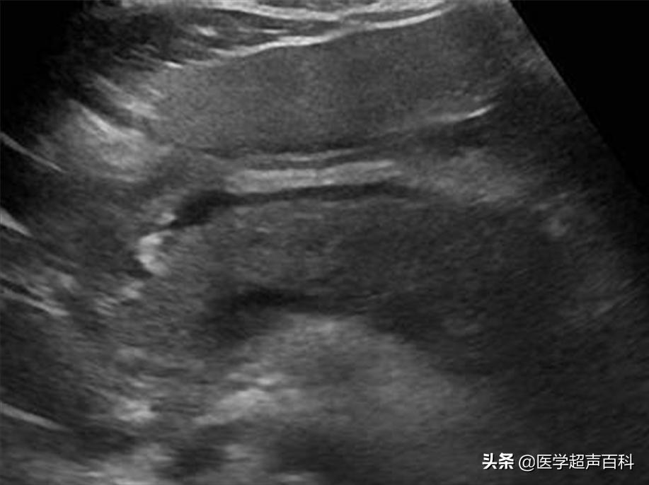 急性胰腺炎超声表现,犬急性胰腺炎超声