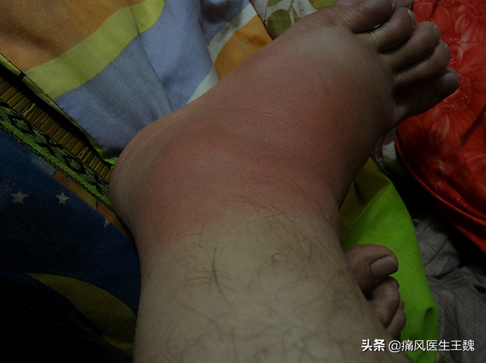 源头降尿酸王魏：非布司他该怎么吃能避出现痛风反反复复的情况？