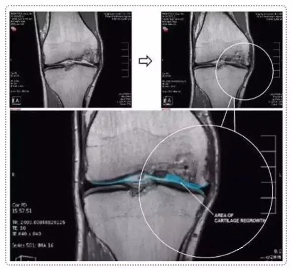 干细胞治疗膝关节软骨缺损,干细胞注射膝关节可以修复软骨吗