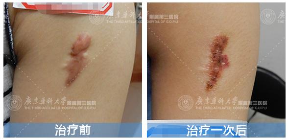 疤痕治疗能恢复原样吗,疤痕治疗了2年了还是红痒