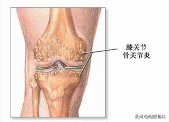骨刺和骨性关节炎哪个更严重,骨刺也是骨性关节炎吗