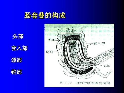 便血可触及腹部包块,肠套叠肚子轻微疼痛