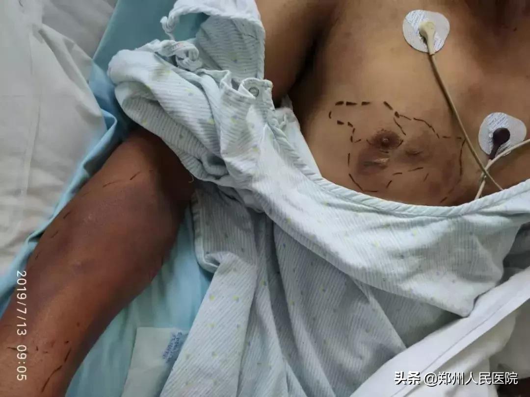 “砰”的一声，我把自己送进了ICU—“一位电击伤患者的自述”