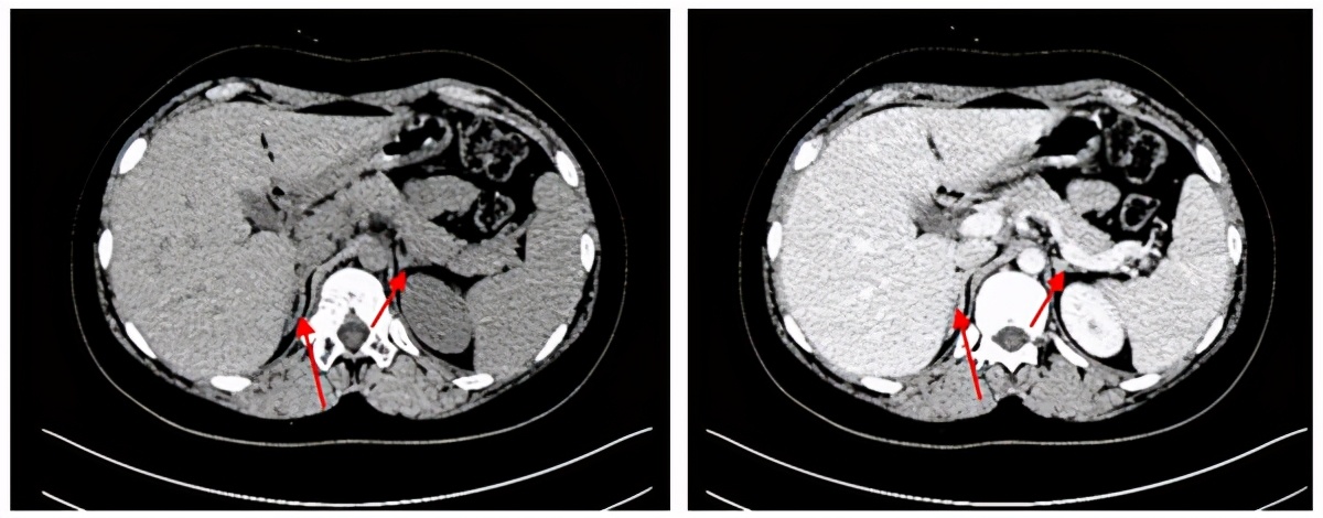 先天性肾上腺素组织增生症,肾上腺皮质增生羟化酶缺陷症