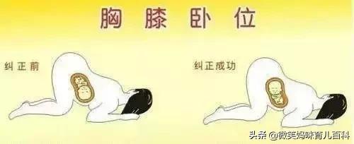 治胎位不正的穴位,胎位不正妇产医生矫正