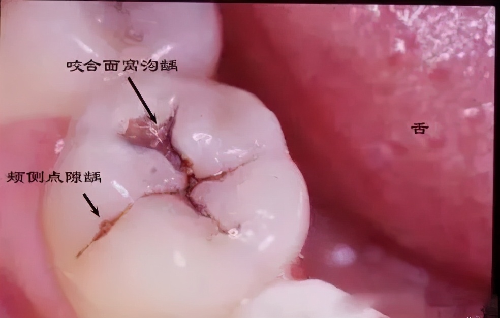 窝沟封闭预防儿童蛀牙的好方法,儿童窝沟封闭预防龋齿有什么危险