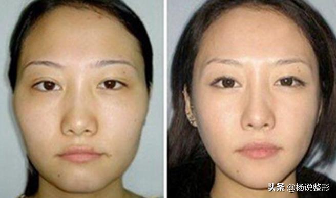 20岁面部凹陷如何改善,脂肪填充面部凹陷怎么导致的呢