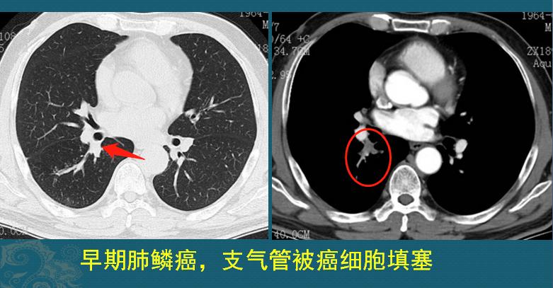 肺鳞癌是怎么长出来的？怎样早期发现？医生教你看CT片